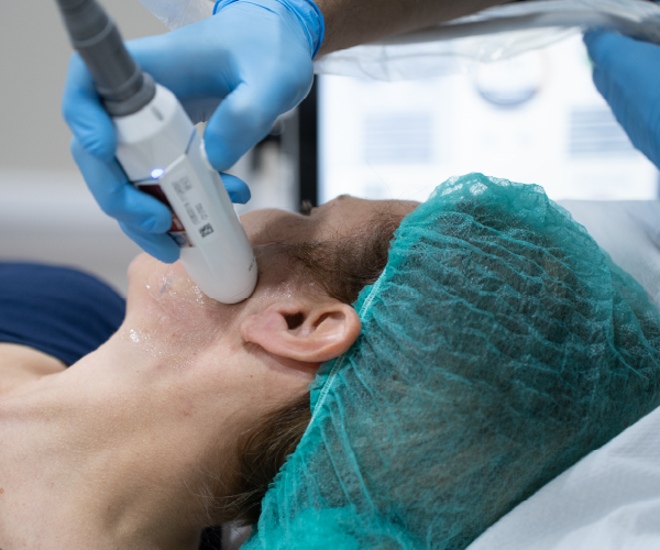 Pormenor do tratamento Liftera na Glow Clinic